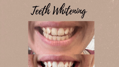 Teeth Whitening Photo