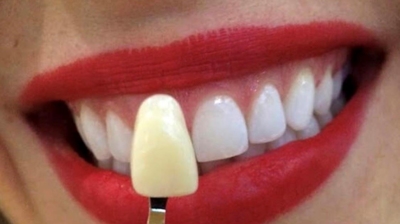 Teeth Whitening Photo