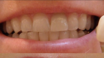 Teeth Whitening Before and After Photo