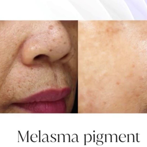 Laser IPL Treatments NuBody Solutions